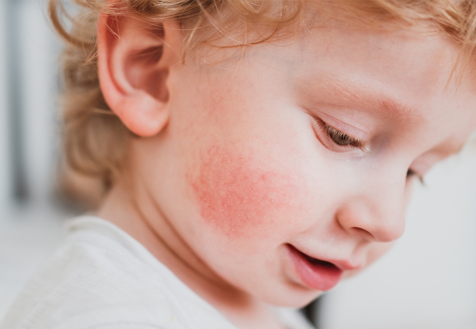 Allergies on the rise